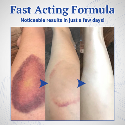 Skintensiv™ Bruises Relief Cream🚀Fade Bruises in Days, Not Weeks – Clinically Proven Transdermal Care. 🚀